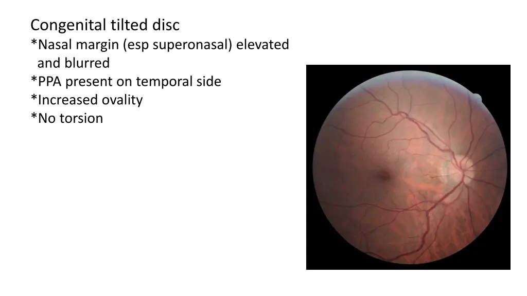 congenital tilted disc nasal margin