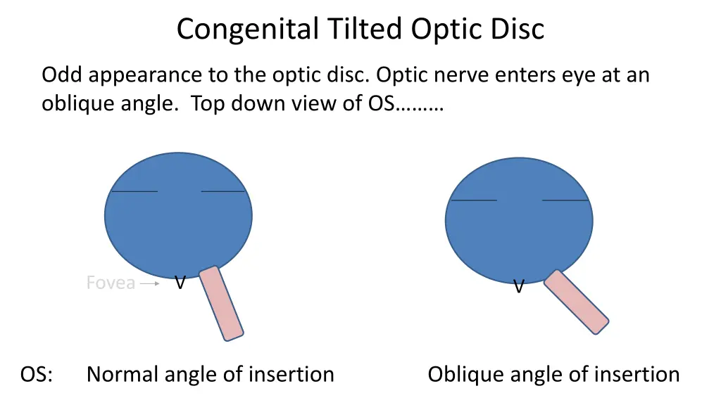 congenital tilted optic disc