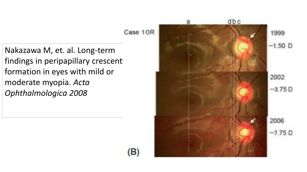 nakazawa m et al long term findings