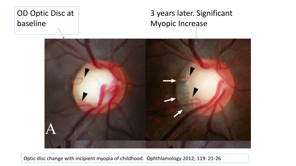 od optic disc at baseline
