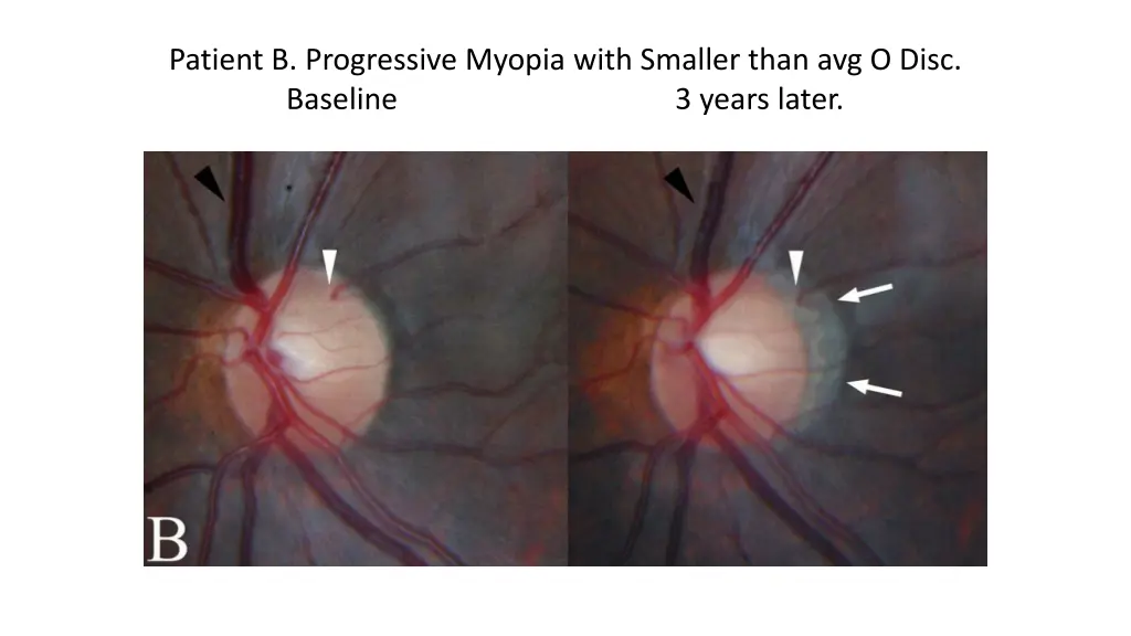 patient b progressive myopia with smaller than