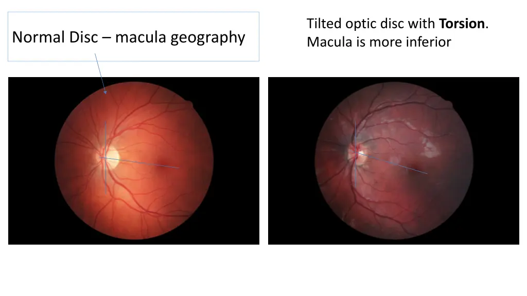 tilted optic disc with torsion macula is more