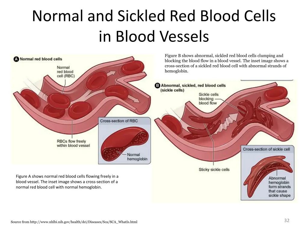 normal and sickled red blood cells in blood