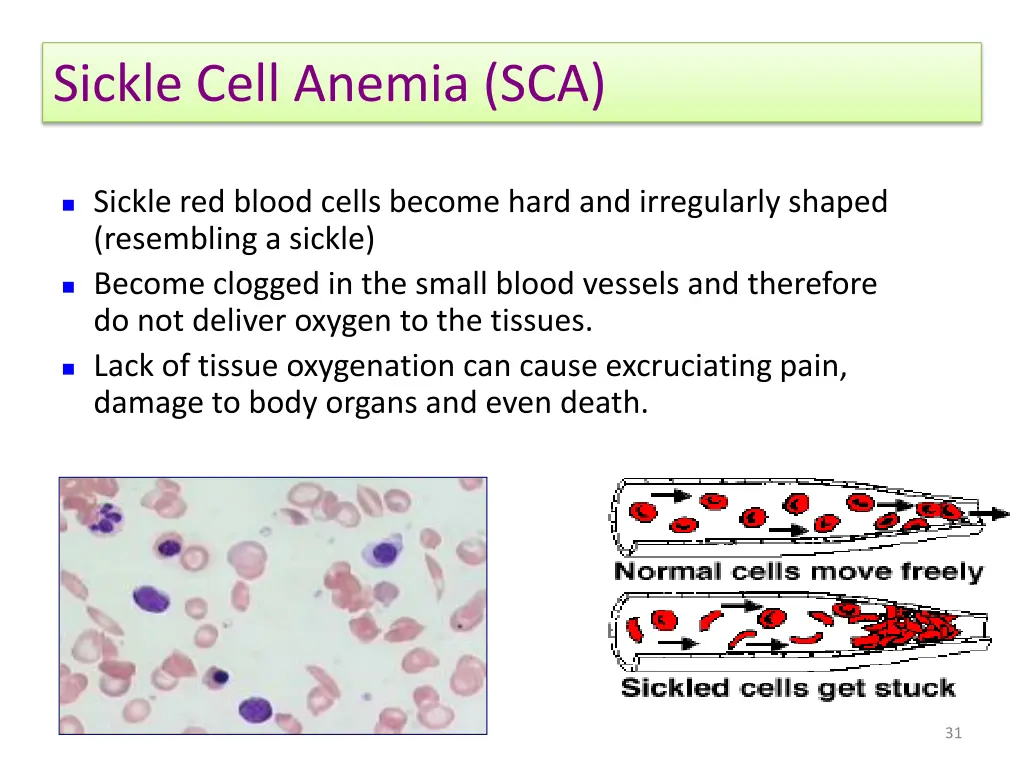 sickle cell anemia sca