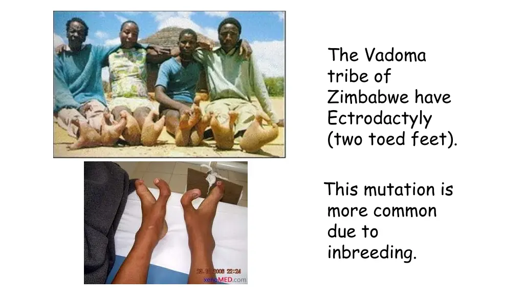 the vadoma tribe of zimbabwe have ectrodactyly