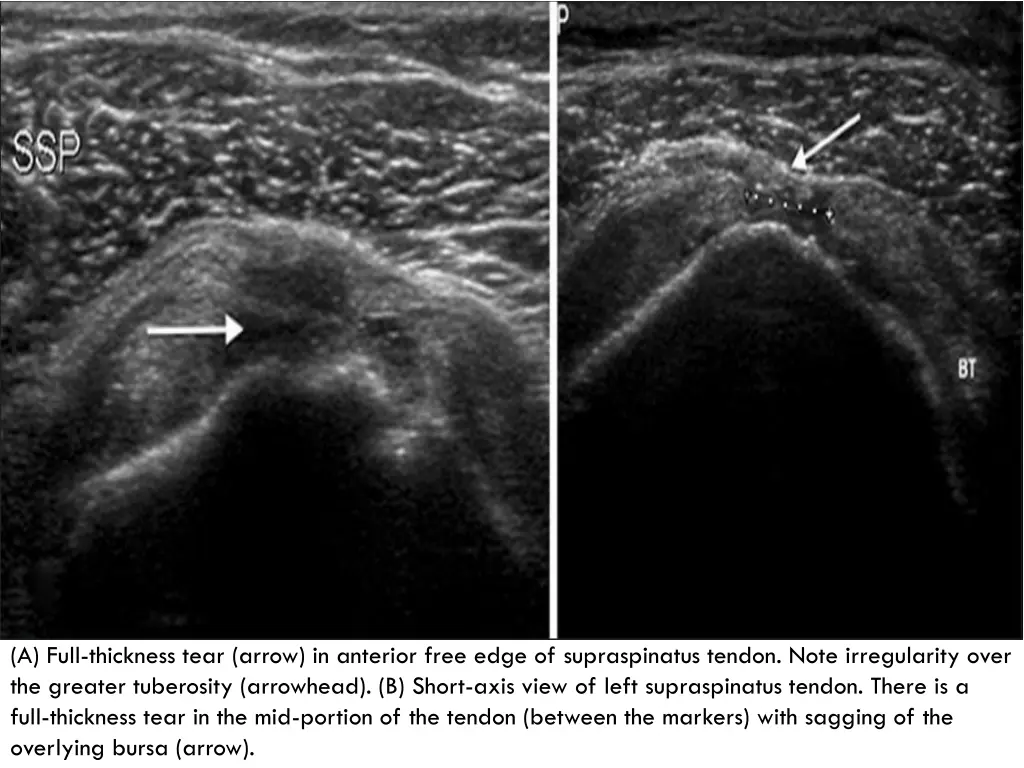 a full thickness tear arrow in anterior free edge
