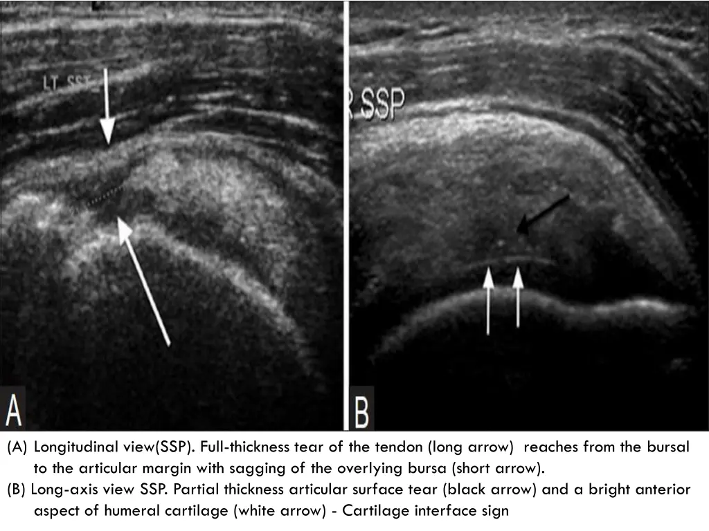 a longitudinal view ssp full thickness tear