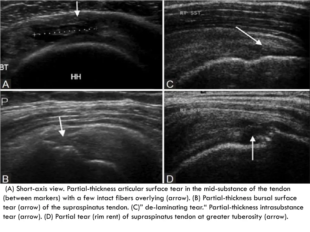 a short axis view partial thickness articular