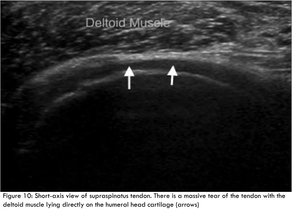 figure 10 short axis view of supraspinatus tendon