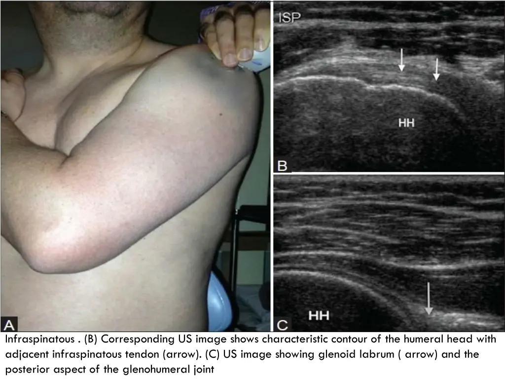 infraspinatous b corresponding us image shows