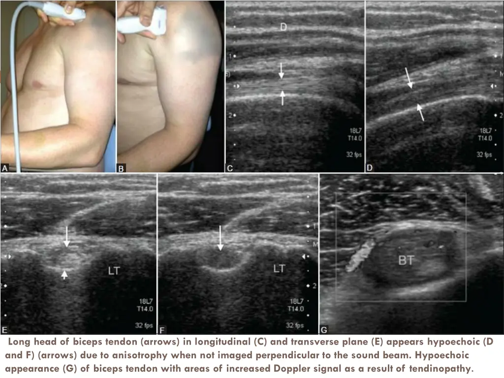 long head of biceps tendon arrows in longitudinal