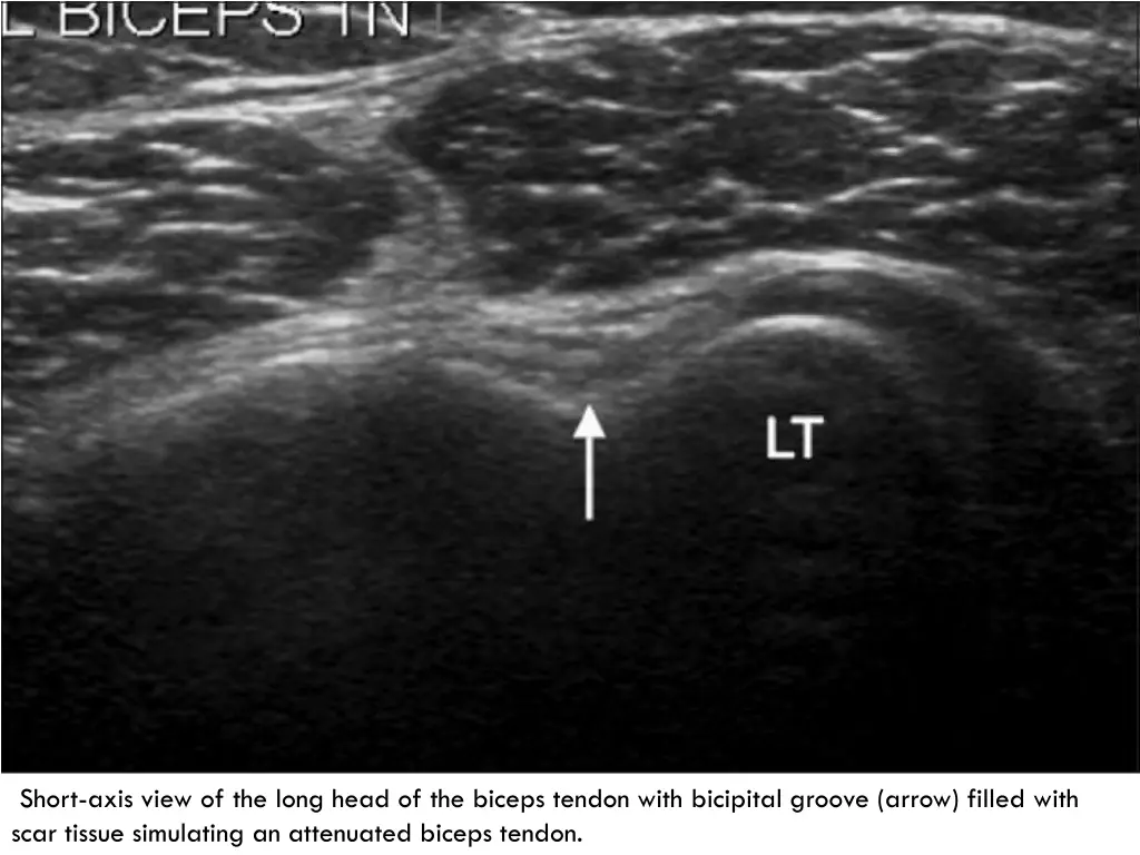 short axis view of the long head of the biceps