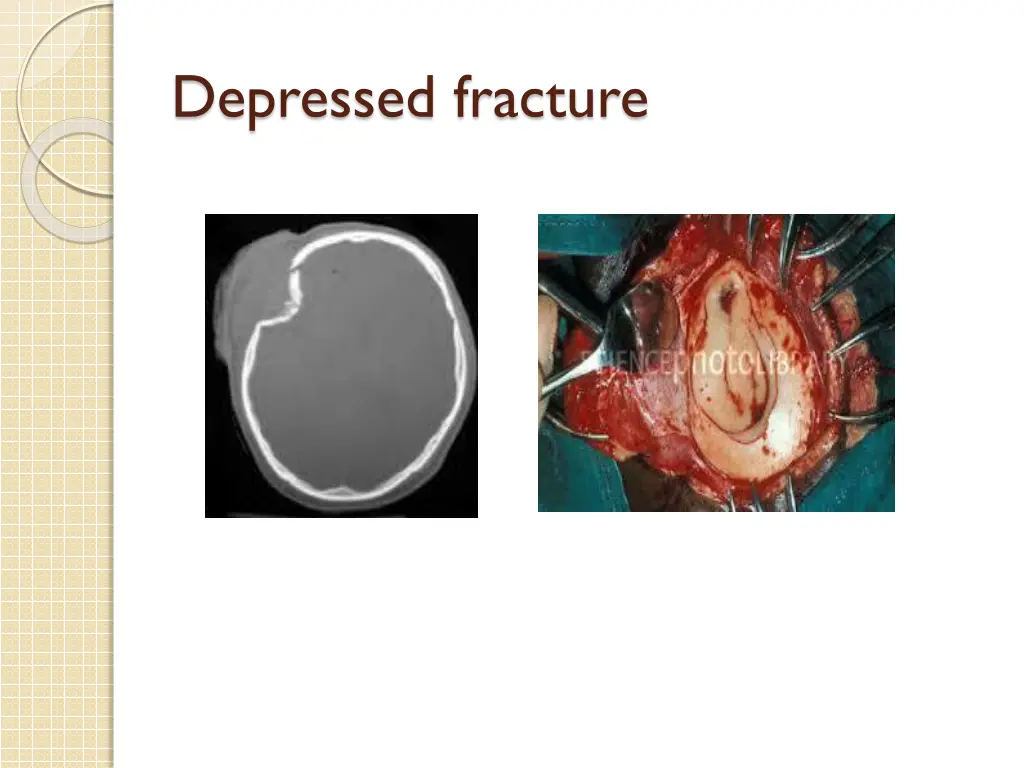 depressed fracture