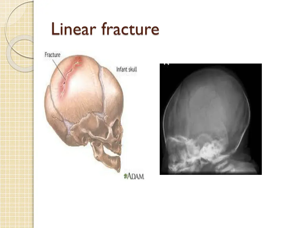 linear fracture