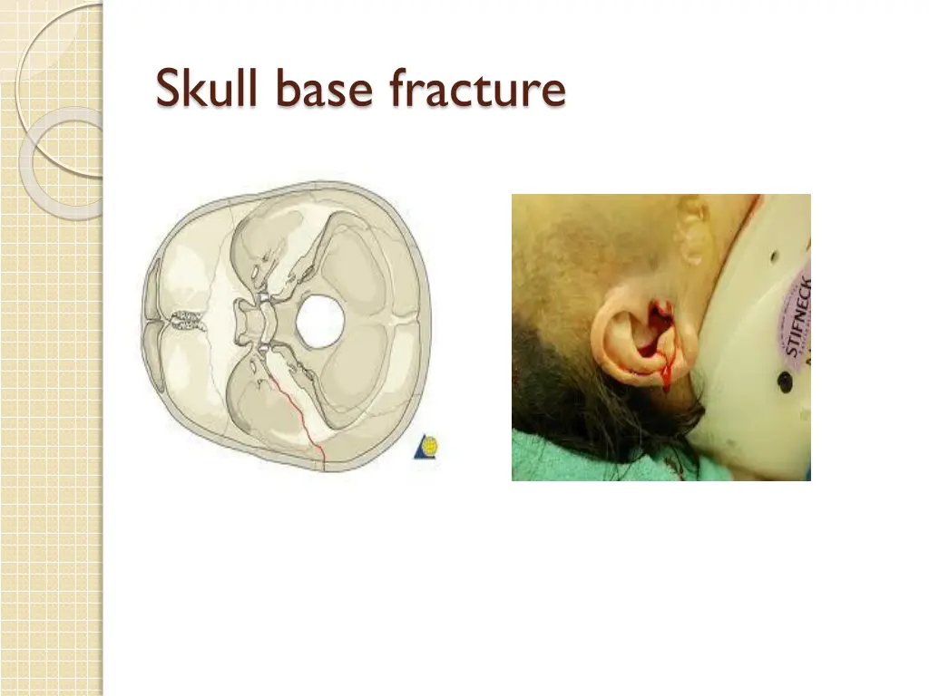 skull base fracture