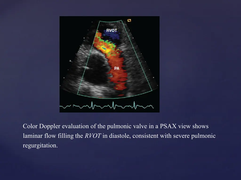 color doppler evaluation of the pulmonic valve