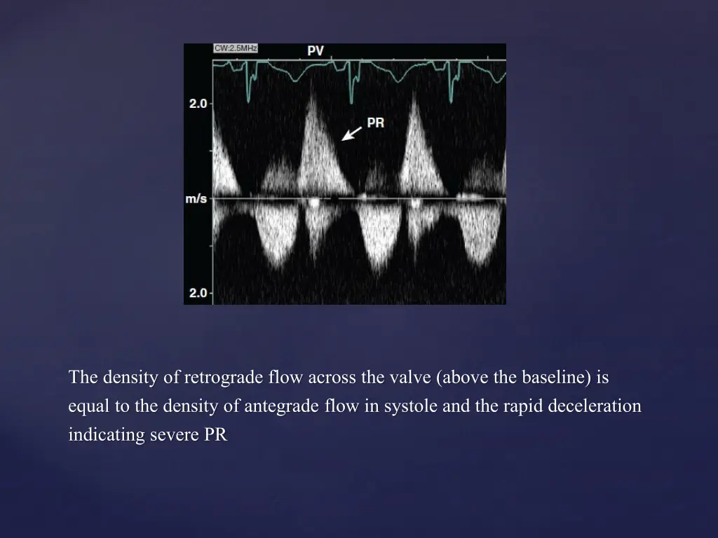 the density of retrograde flow across the valve