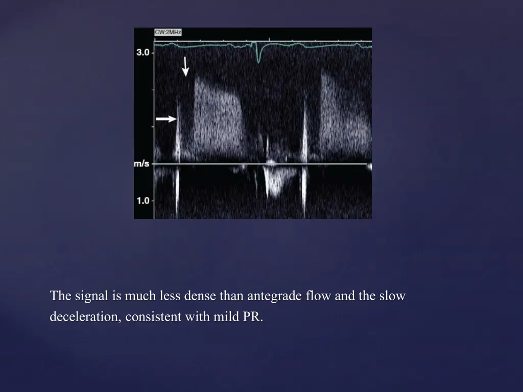 the signal is much less dense than antegrade flow