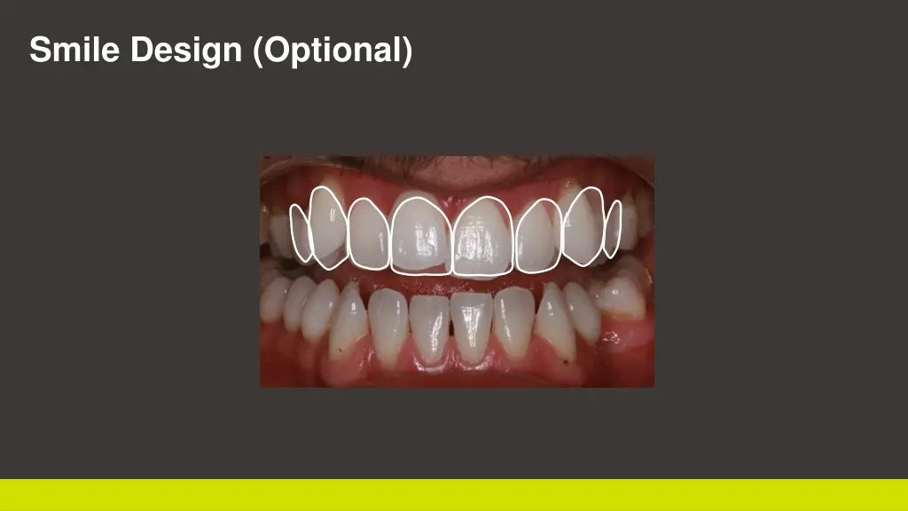 smile design optional