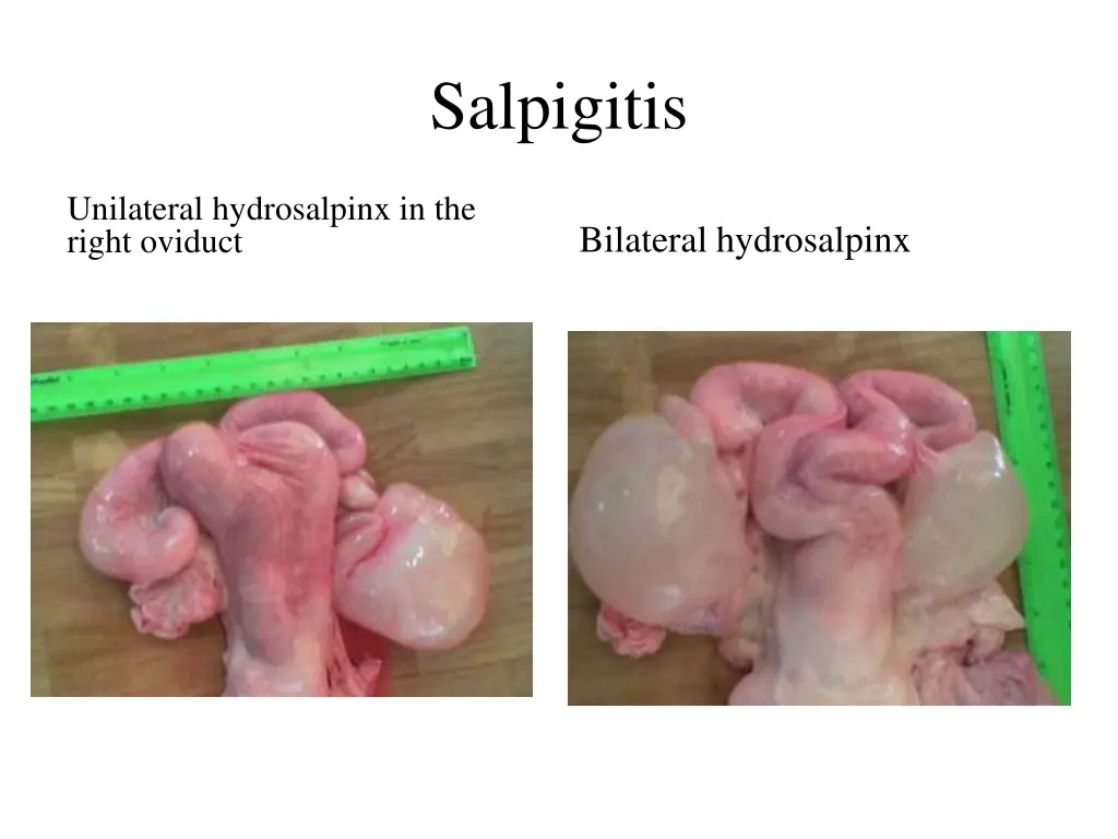 salpigitis