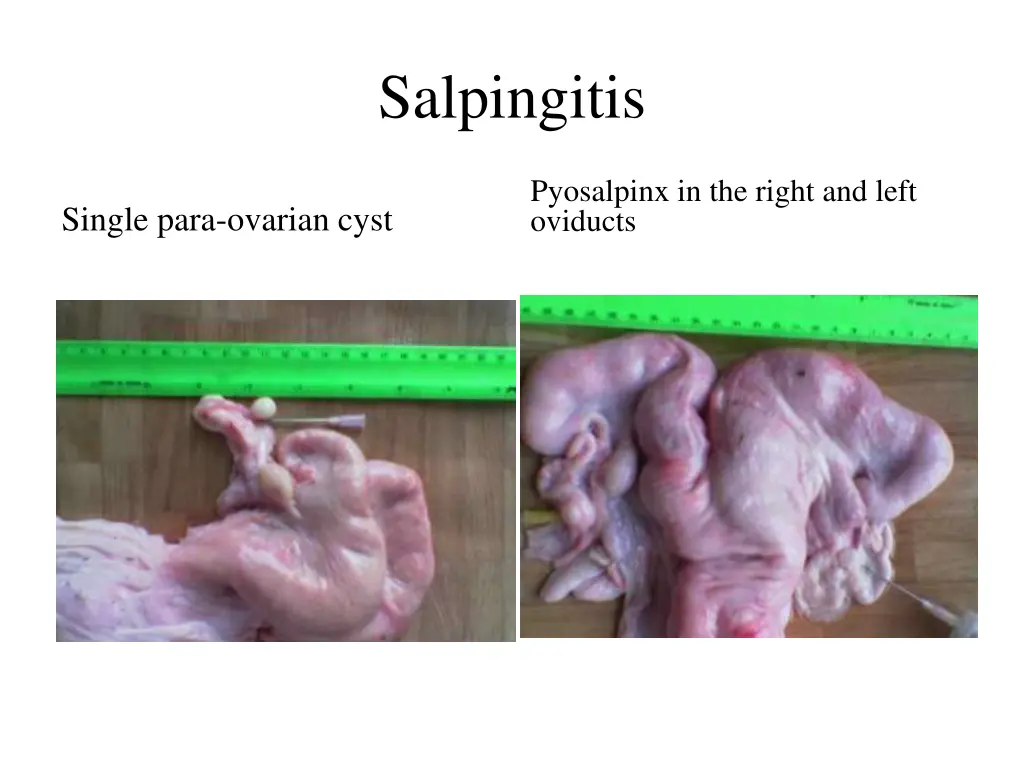 salpingitis