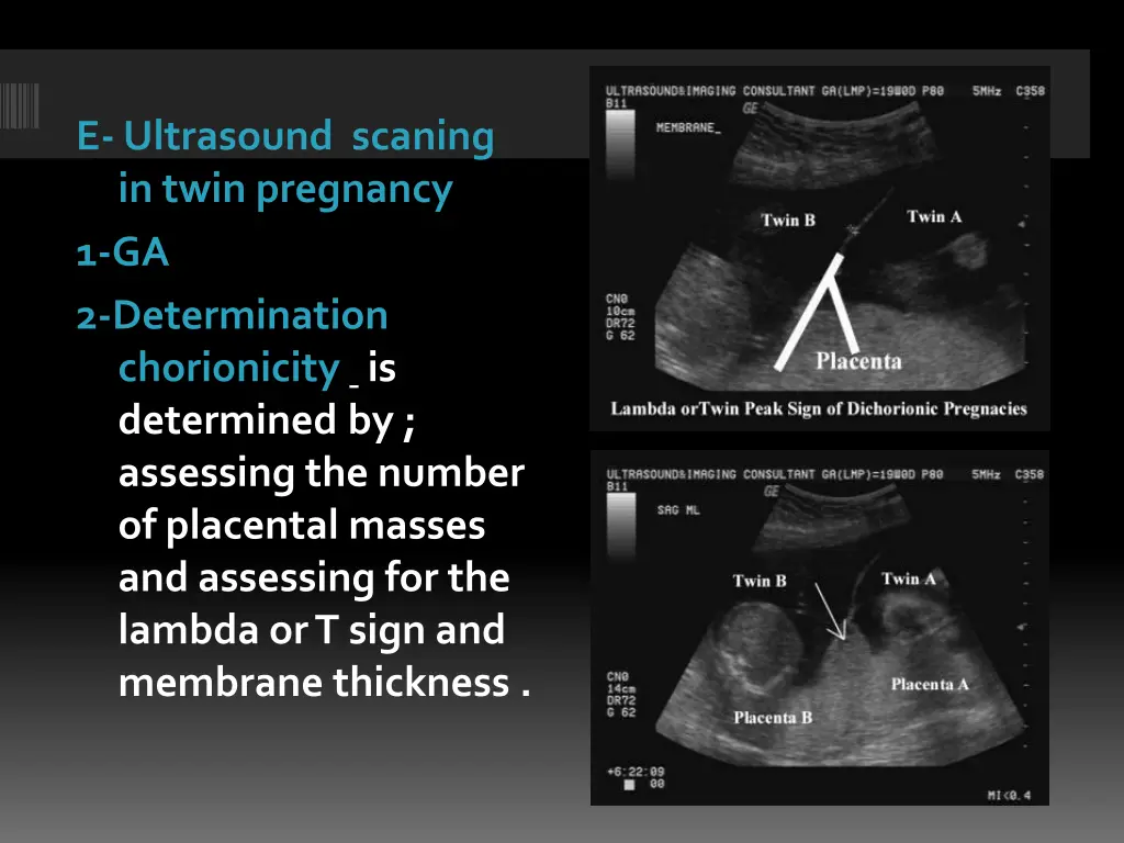 e ultrasound scaning in twin pregnancy