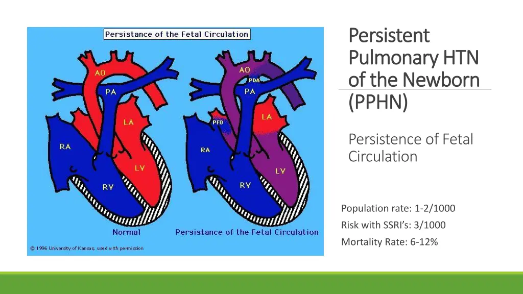 persistent persistent pulmonary htn pulmonary