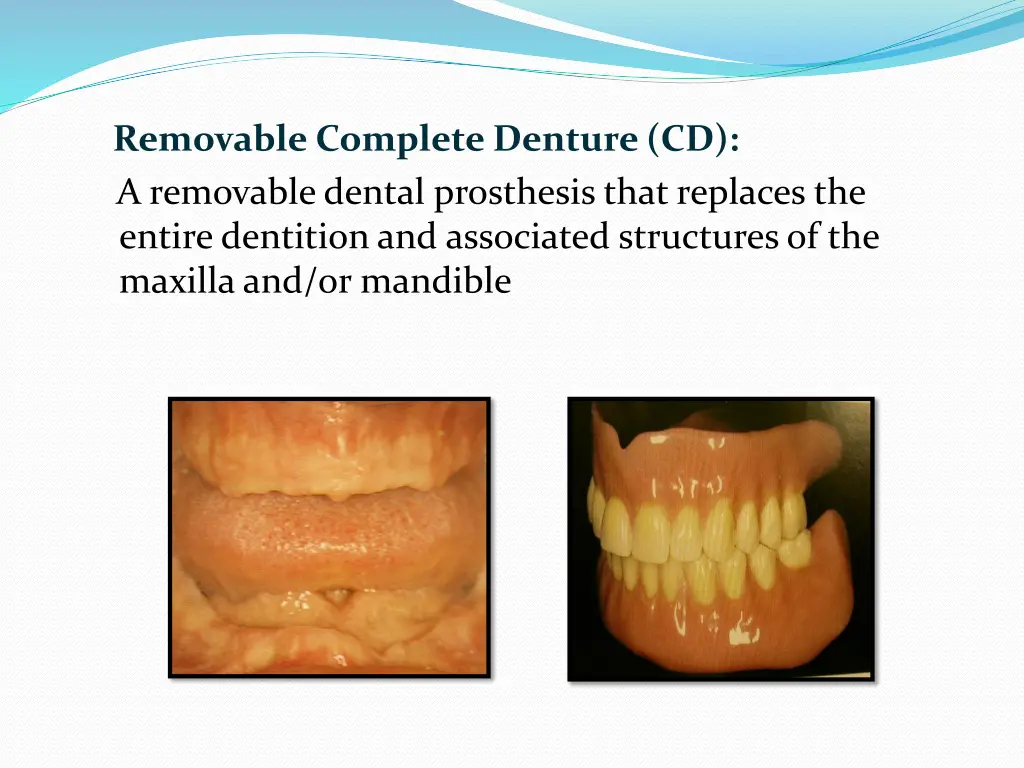 removable complete denture cd a removable dental