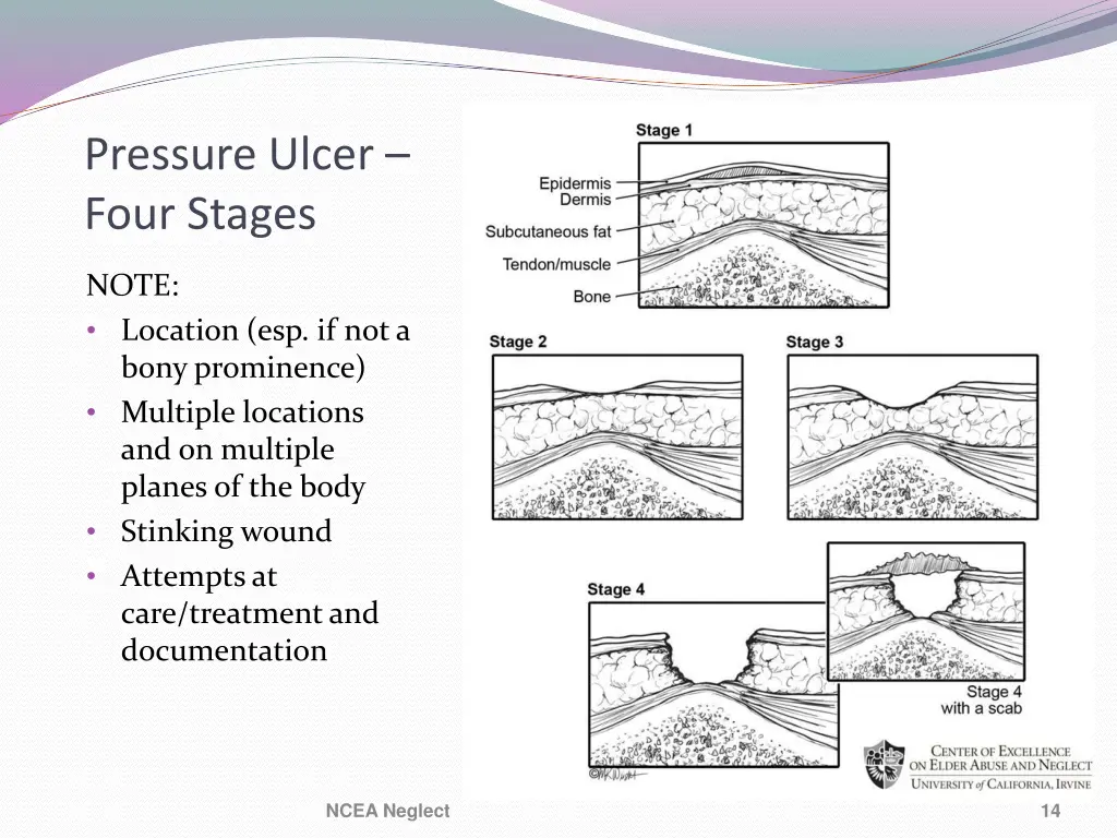 pressure ulcer four stages