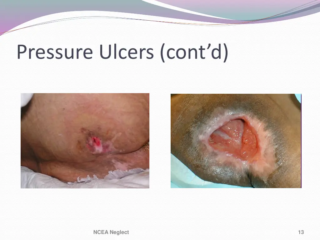 pressure ulcers cont d