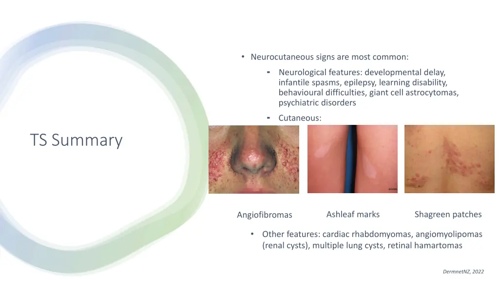 neurocutaneous signs are most common neurological