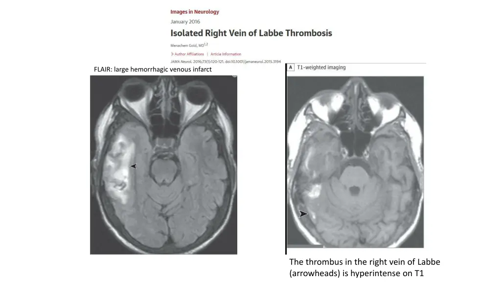 flair large hemorrhagic venous infarct