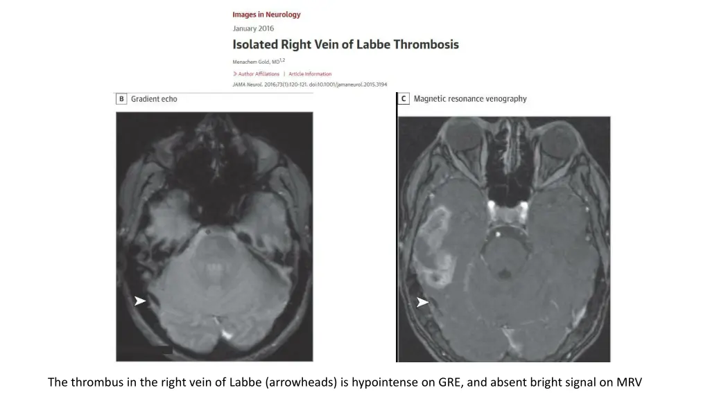 the thrombus in the right vein of labbe
