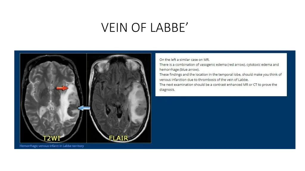 vein of labbe 6