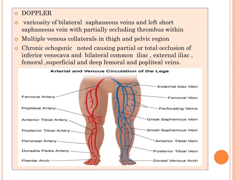 doppler varicosity of bilateral saphaneous veins