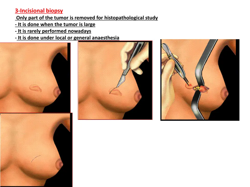 3 incisional biopsy only part of the tumor