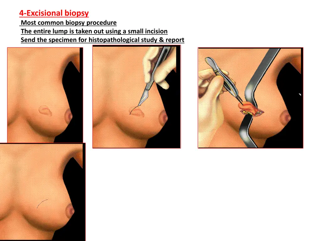 4 excisional biopsy most common biopsy procedure