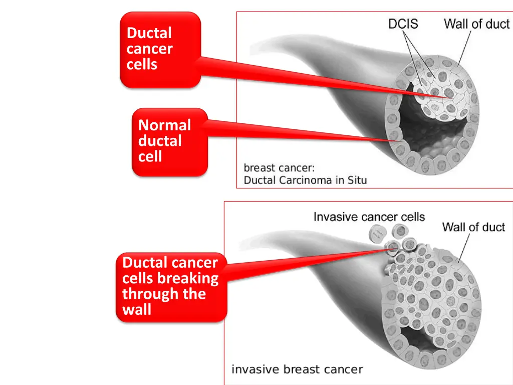 ductal cancer cells