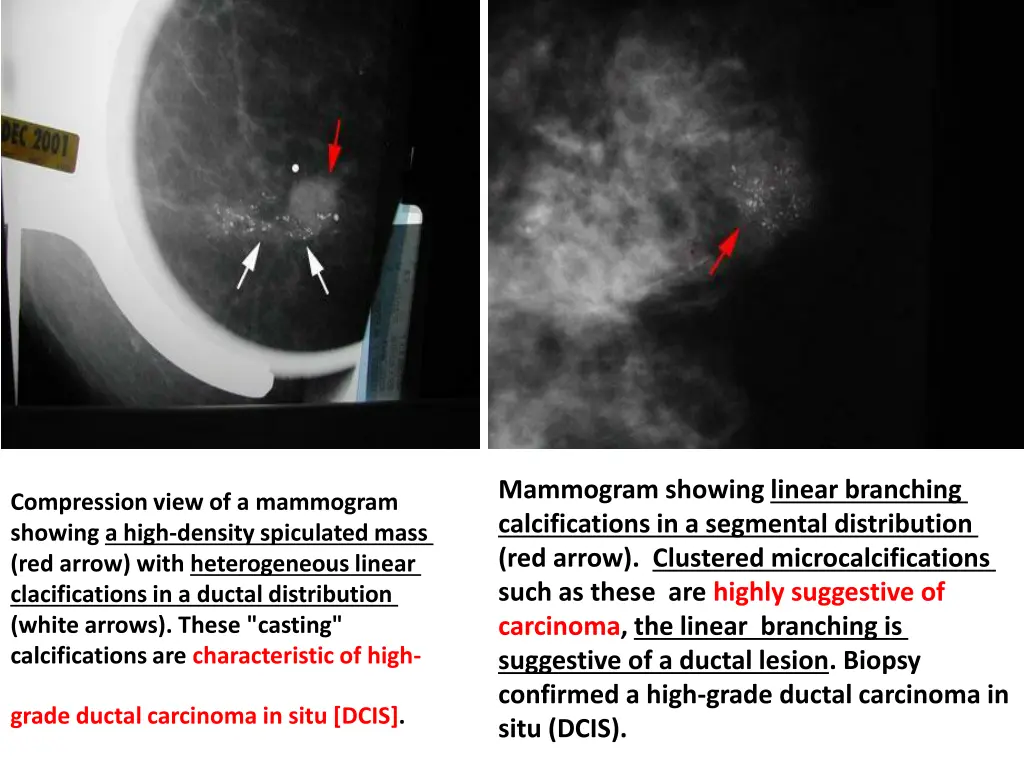mammogram showing linear branching calcifications