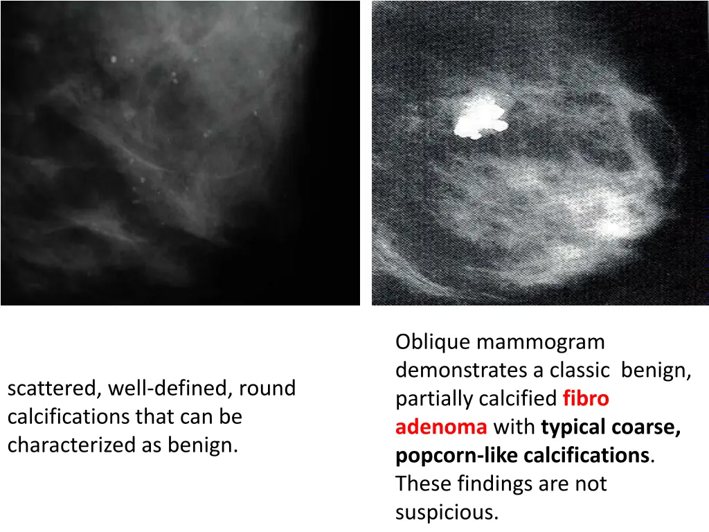 oblique mammogram demonstrates a classic benign