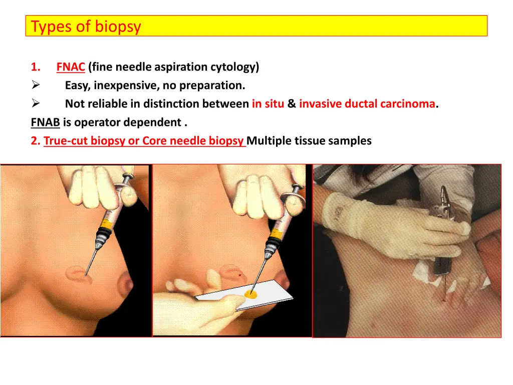 types of biopsy
