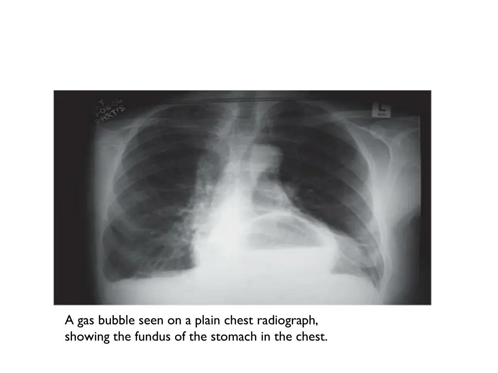 a gas bubble seen on a plain chest radiograph