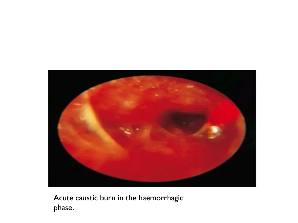 acute caustic burn in the haemorrhagic phase