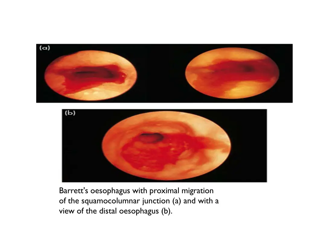 barrett s oesophagus with proximal migration