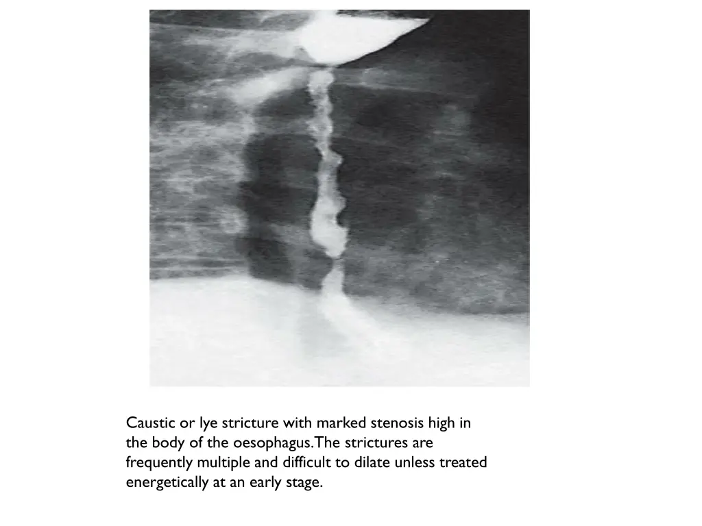 caustic or lye stricture with marked stenosis