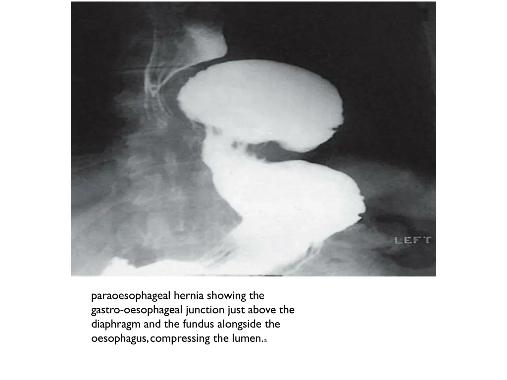 paraoesophageal hernia showing the gastro