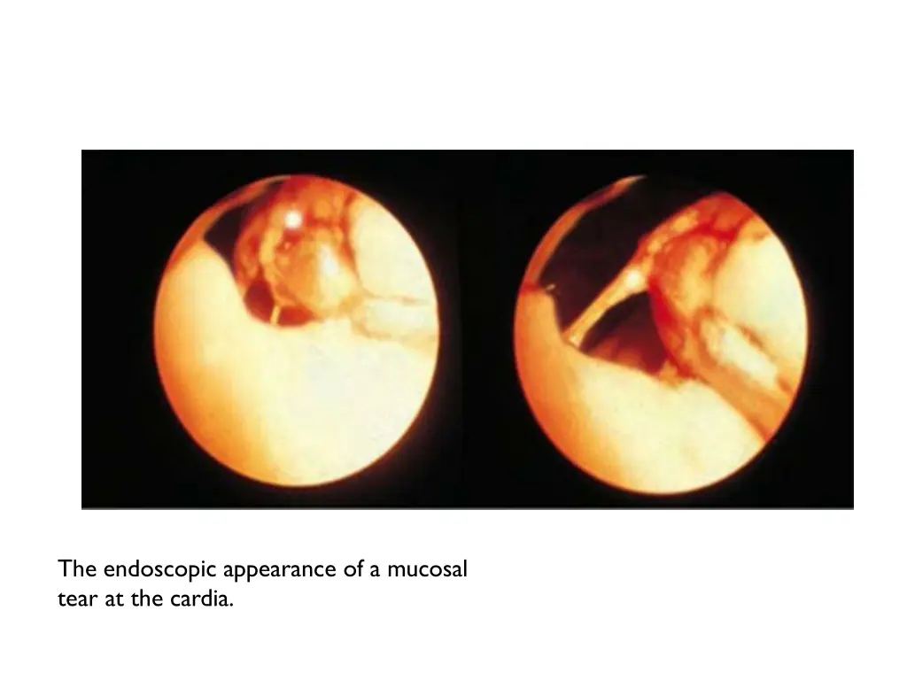 the endoscopic appearance of a mucosal tear