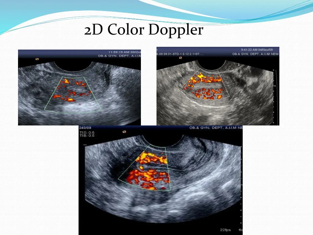 2d color doppler