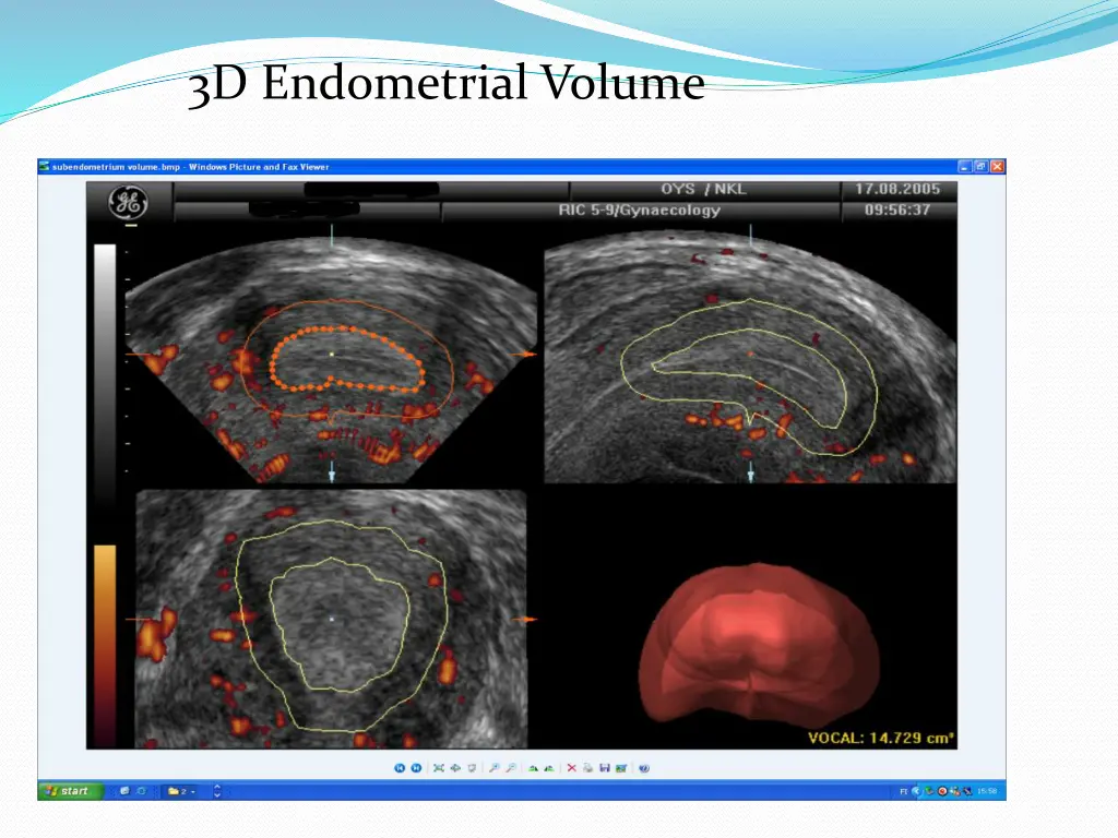 3d endometrial volume