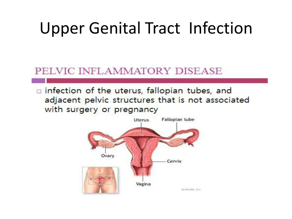upper genital tract infection 2